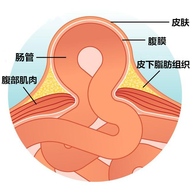 腹股沟疝十问十答原创