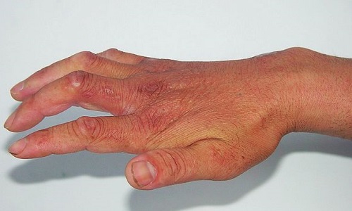 专家为您分析多发性肌炎发病根源