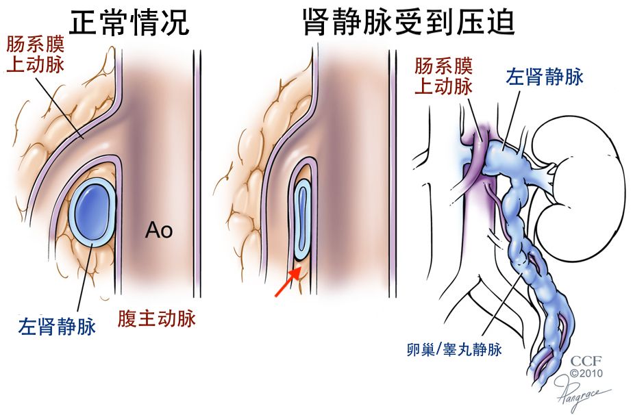 女性胡桃夹现象图片