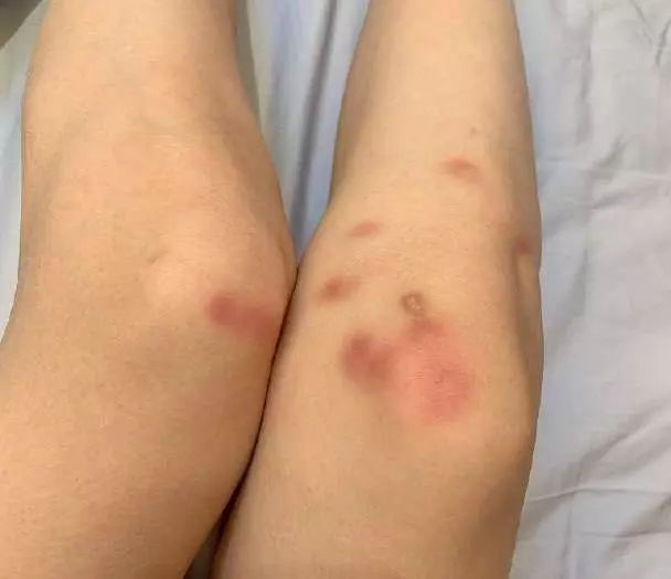 昆萨家暴毒打,从她在社交平台控诉的图片可以看出张雅腿部伤痕累累,青