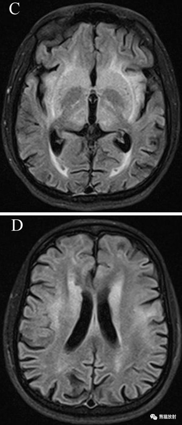 圖 a~d 頭顱 mri flair 序列顯示延髓,腦橋,中腦,丘腦,殼核,尾狀核和