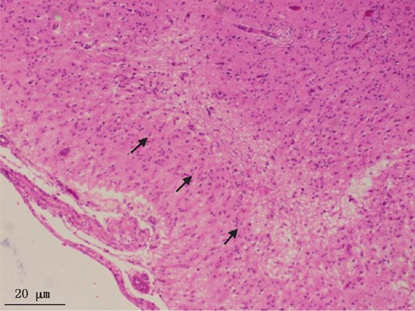 毛细血管以及星形胶质细胞增生(箭头)he染色不同类型的线粒体病可以