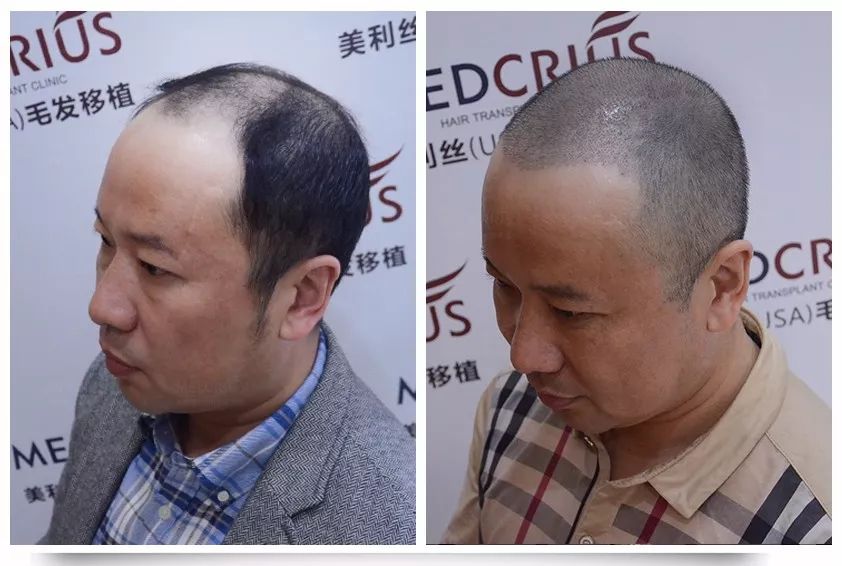 别低头假发会掉中年男人的脆弱你想象不到