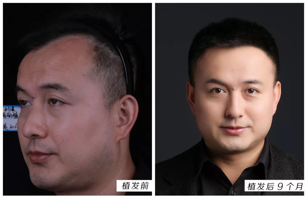 遗产掉发能植发吗(遗产性脱发可以治疗吗)