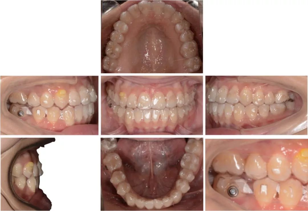 5 mm,下頜擁擠度:1.5 mm.bolton指數:前牙比為86.70%,全牙比為75.5%.