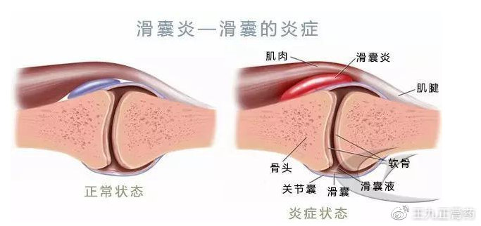 髌腱炎位置图片图片