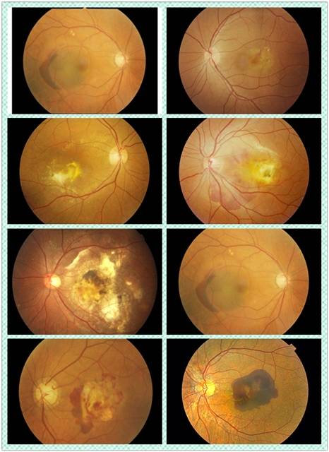 视网膜是形成视觉的重要组织,光线到达功能正常的视网膜后形成视觉