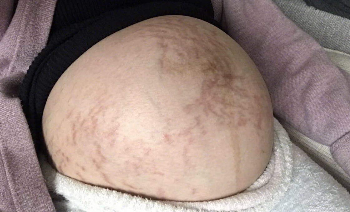 生完孩子的肚子妊娠纹图片