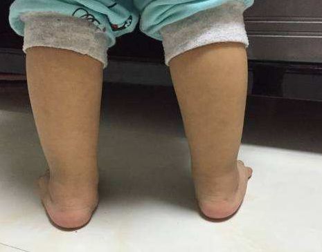 儿童踝关节正常图片图片