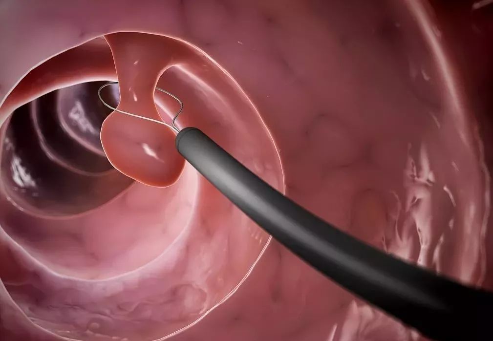 一次肠镜可保17年平安22类人群必须尽快去做检查