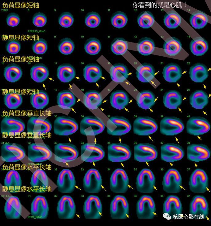 科普危險的心肌危險的程度看得見核素心肌灌注顯像