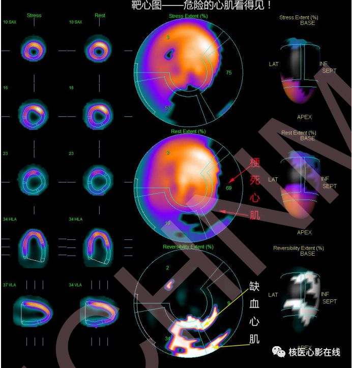 科普危險的心肌危險的程度看得見核素心肌灌注顯像