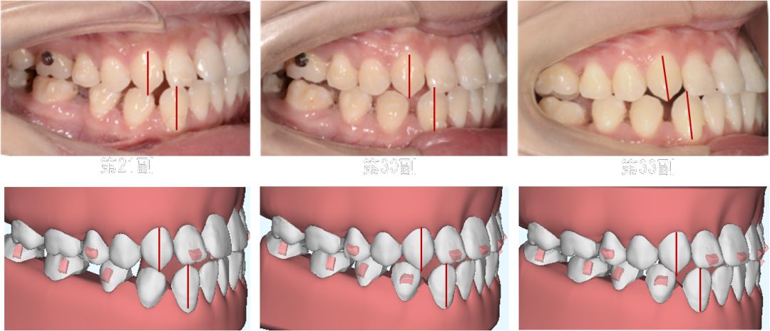 因为这个原因,实现了比矫治设计更好的尖牙磨牙关系.