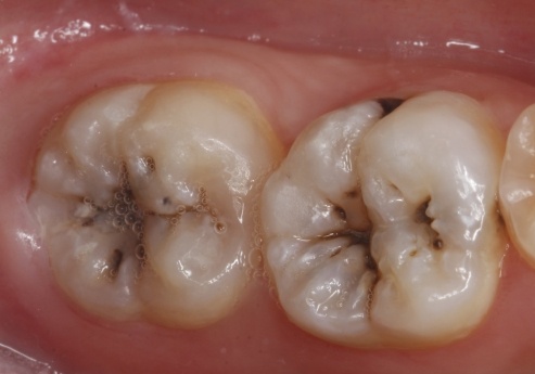 会有牙菌斑附着,如果没有及时清除,细菌还会腐蚀牙体,可能引起继发龋
