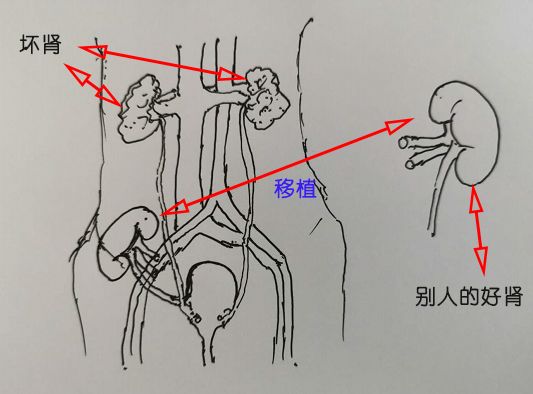 強悍!中大五院3小時生命接力,讓2人重獲新生_患者