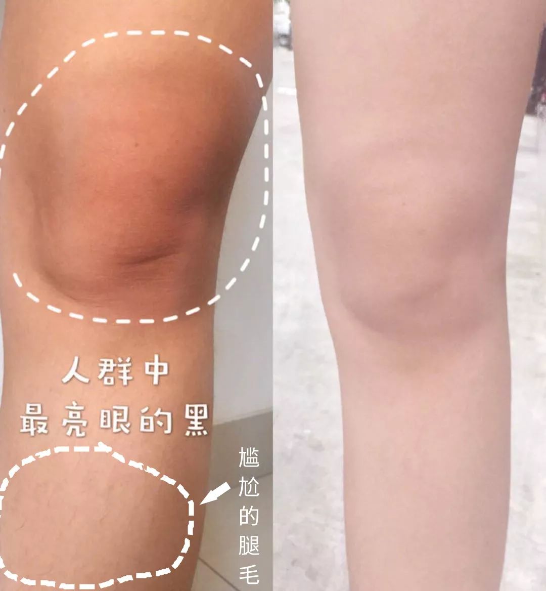 冬季膝盖鸡皮肤(冬天大腿上鸡皮肤)