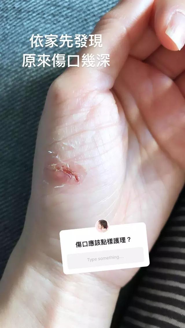 tvb视后为拍新剧弄伤手伤口深见肉 发文:现在才发现