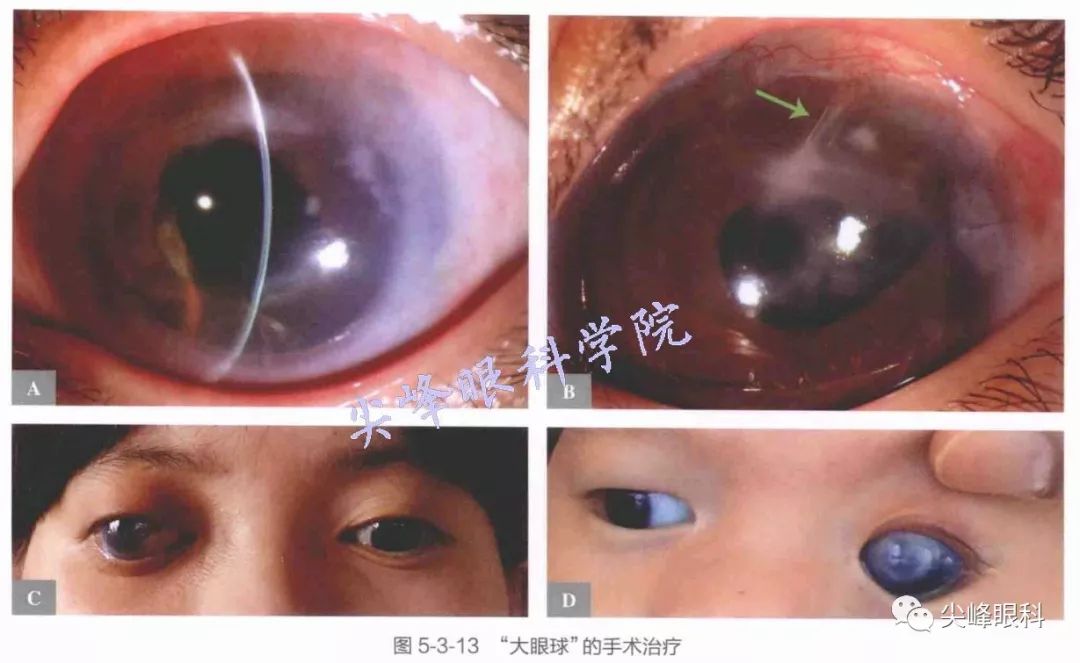 与儿童青光眼手术相关的问题并发症及处理问题解答part09图解青光眼