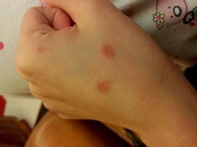 养狗人士请注意这些病易让人狗互相传染