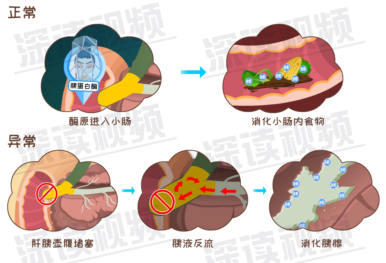 这样吃喝竟会招来高致死率的胰腺炎?预防大全