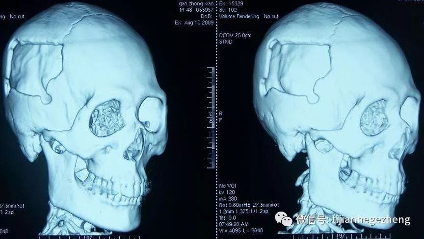 三维重建头颅ct扫描通常适用于既往有颅脑损伤病史,颅脑较大疤痕,颅骨