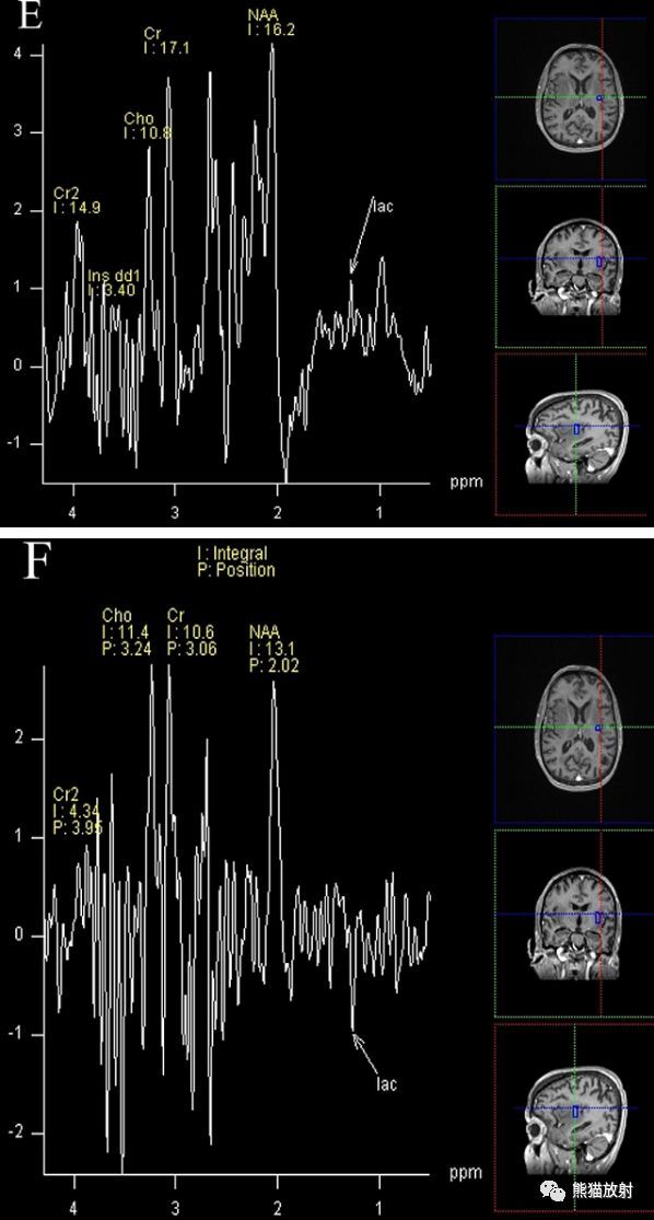 leigh综合征丨脑mri表现,诊断及鉴别诊断