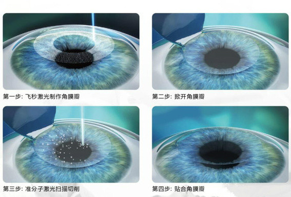 准分子激光手术