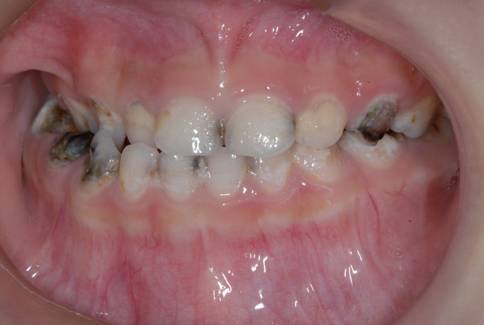 全麻下儿童牙病治疗的安全原则——钱虹主任医师