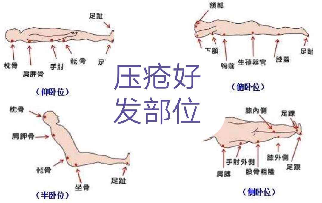 压疮好发部位的示意图图片