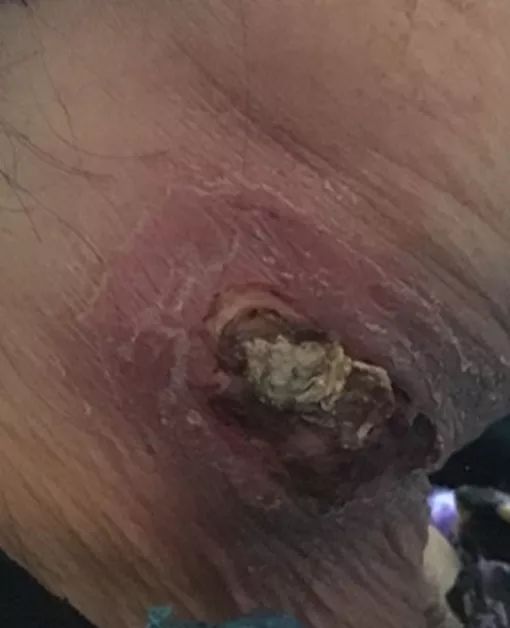 脓肿型结节型淋巴结结核是一种常见的结核病,好发于在颈淋巴结,腋窝