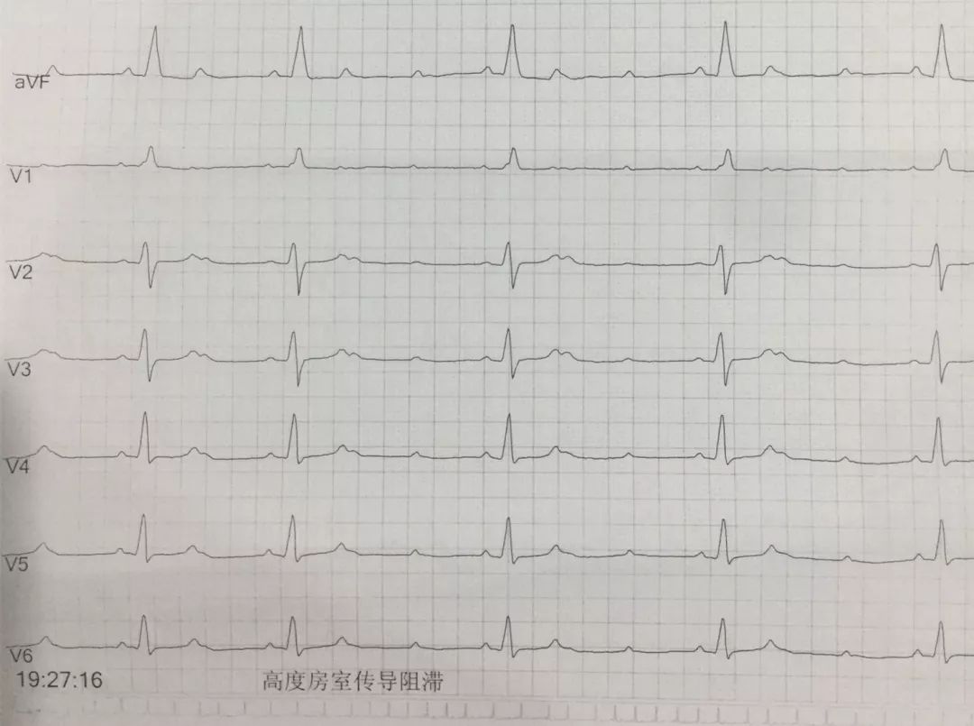 "病毒性心肌炎与病毒性感冒密不可分,往往感冒高发的季节,病毒性心肌