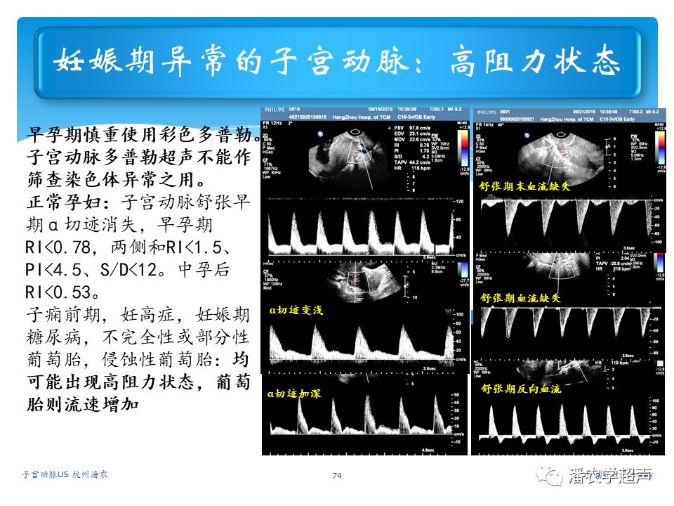 子宫动脉阻力高图片