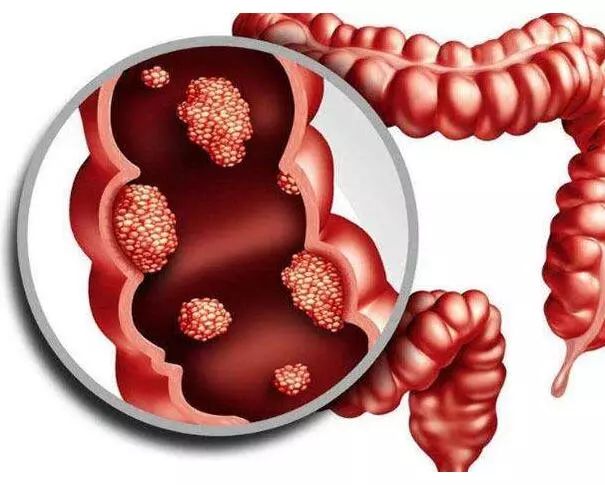 擔心大腸息肉會癌變這八大問題解答你所有疑惑