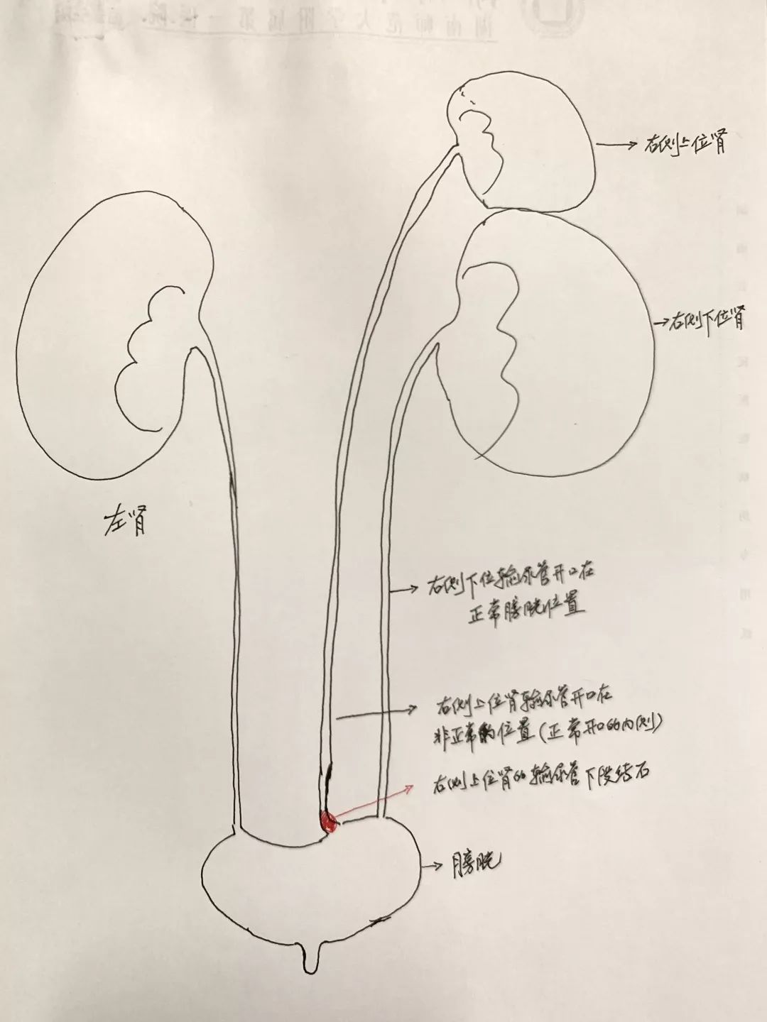 右邊長兩個腎臟兩條輸尿管卻只有一張