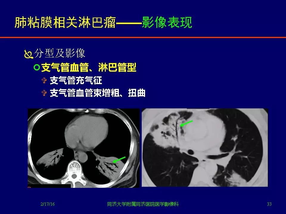 肺粘膜相关淋巴瘤影像特征影像天地