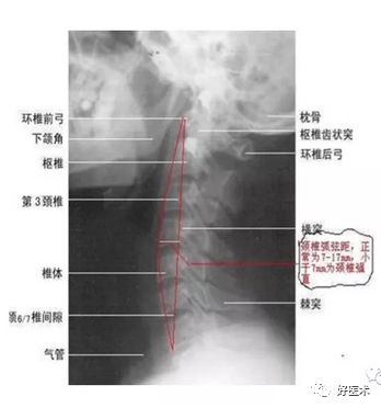 颅底角测量图片