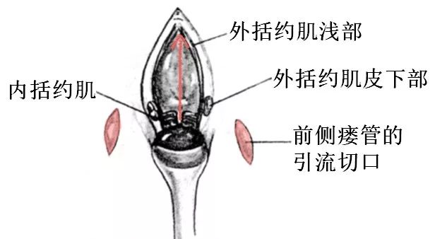 马蹄形肛瘘图片图解图片