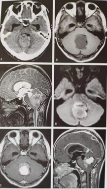 禾醫助分享小腦病變的影像鑑別要點看這篇就夠了
