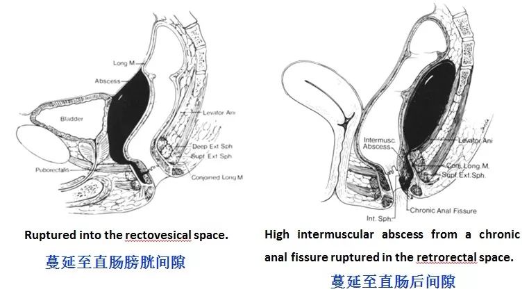 马蹄形肛瘘图片图解图片