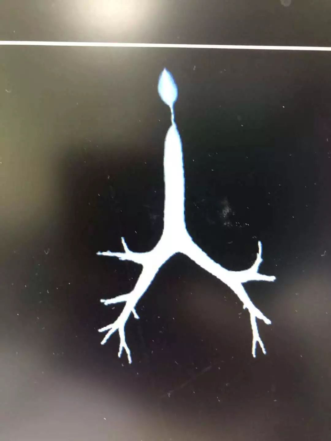 终于,手术成功,4毫米,5毫米……进行气管狭窄环切及球囊扩张术,内镜室