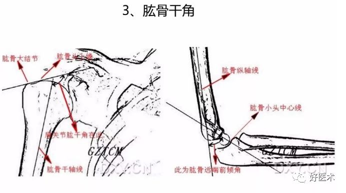 1,肩关节活动角度;2,肱骨颈干角;3,肱骨头后倾角;4,肱骨远端前倾角;5