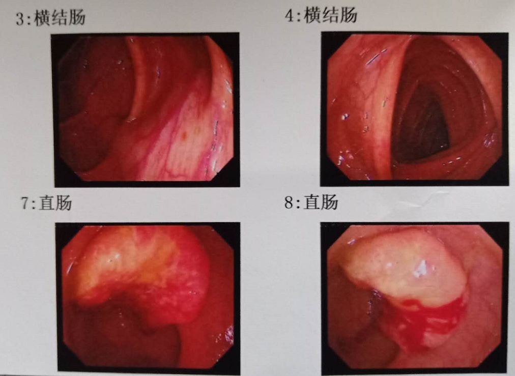 暗红色的血肠癌图片