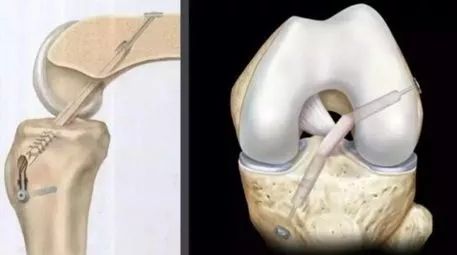 异体材料,人工材料,目前多数使用自体材料进行韧带重建,包括腘绳肌腱