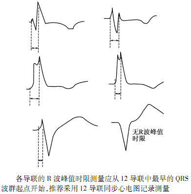 心电图r波切迹的意义图片