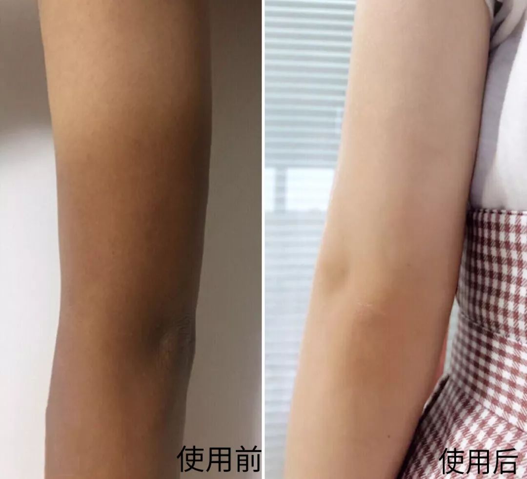 晒成鸡皮肤防晒霜管用吗(晒成鸡皮肤防晒霜管用吗知乎)