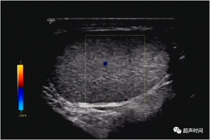正常睾丸附件声像图是图片