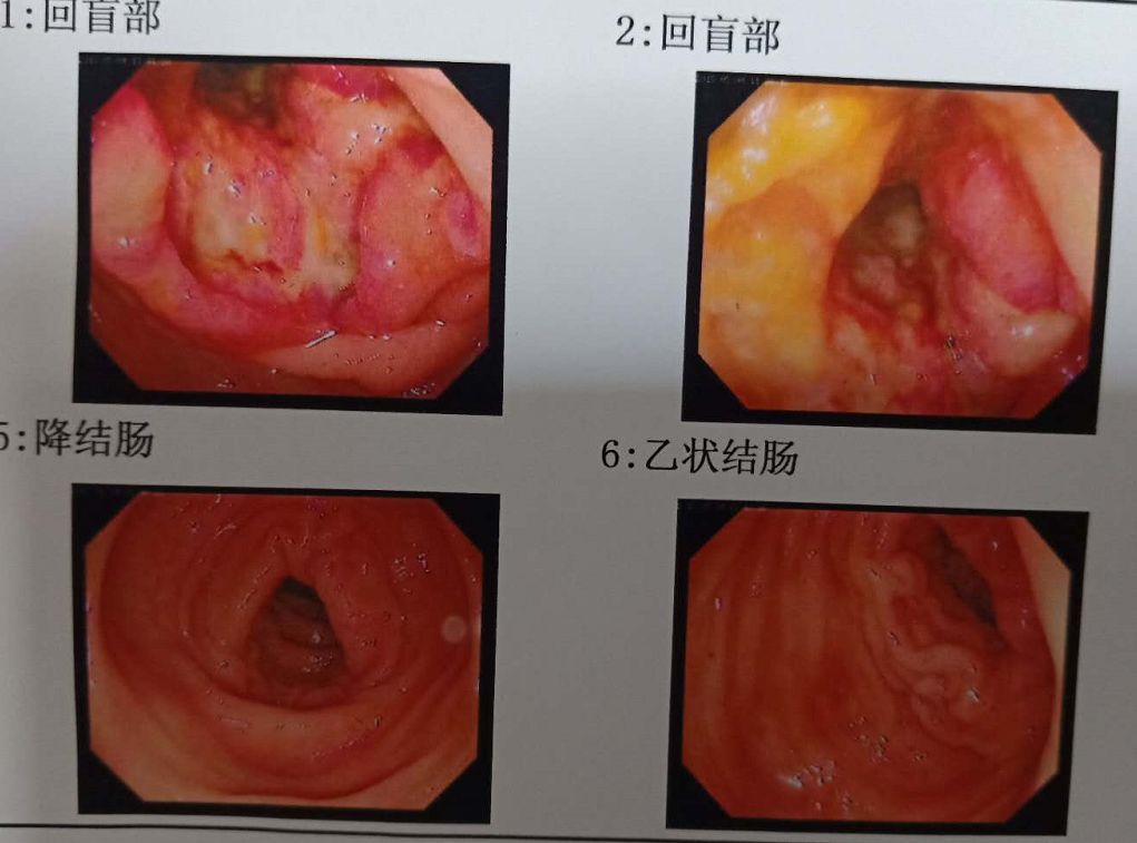 0x50cm的溃疡性新生物,病理结果出来竟是结肠癌