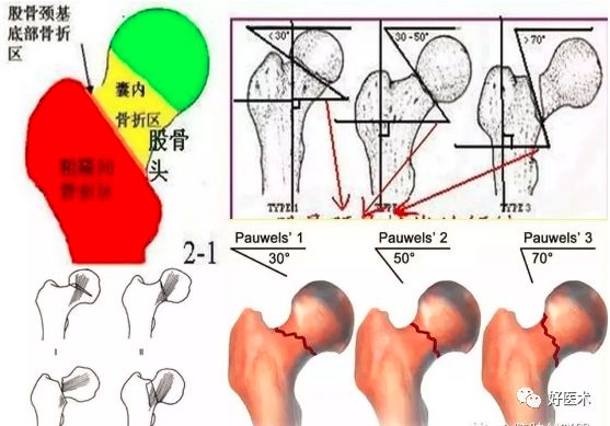 汇总骨科常用角度测量方法全在这里了