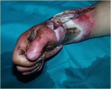 如何区分高压电与低压电损伤