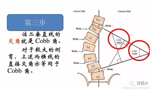 汇总骨科常用角度测量方法全在这里了